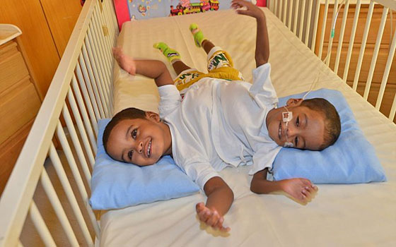   مصر اليوم - الأطباء السعوديّون يبدأون عملية فصل توأم سيامي سوداني السبت