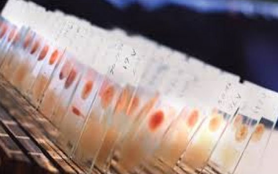   مصر اليوم - وزارة الصحة تؤكّد اكتشاف 11 حالة مصابة بـالملاريا في أسوان