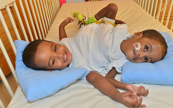   مصر اليوم - الانتهاء من العملية الأصعب لفصل التوأم السوداني بنجاح في الرياض