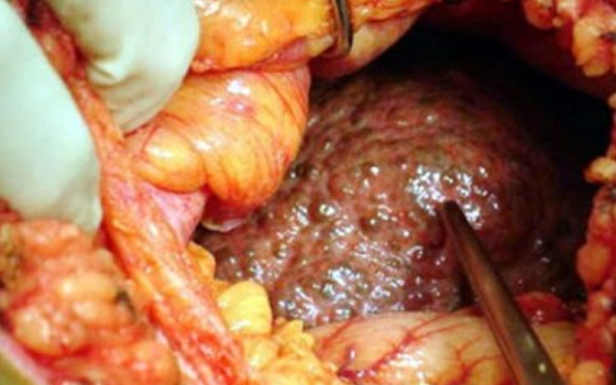   مصر اليوم - استشاري أمراض كبد: مصر خالية من فيروس سي خلال سنوات قليلة