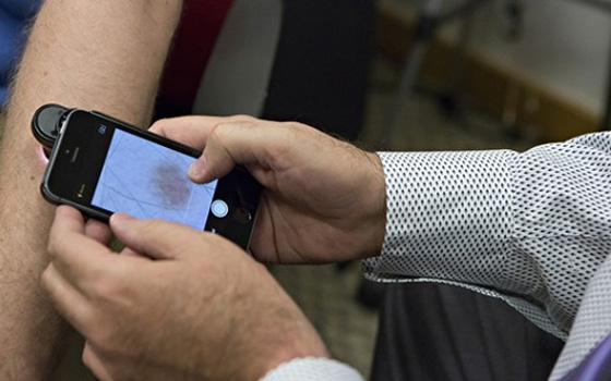   مصر اليوم - باحثون يُطورون تطبيقاً لكشف سرطان الجلد