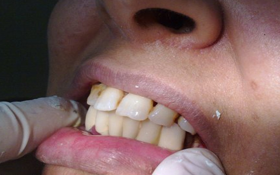   مصر اليوم - تقنية جديدة لإعادة إنماء الأسنان باستخدام ضوء الليزر