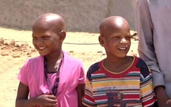   مصر اليوم - إنجاب مواليد يعانون الصلع بإحدى القرى السودانية