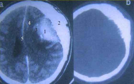   مصر اليوم - إزالة ورم تسبب لطفلة بوليفية بنوبات ضحك شبه مستمرة