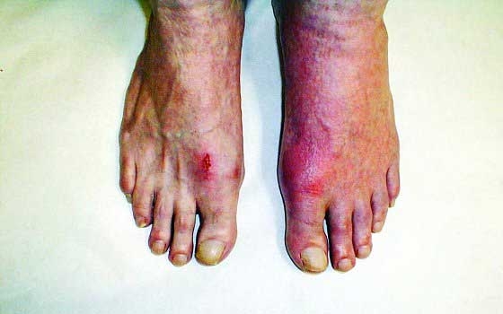   مصر اليوم - طرح أحدث عقار فرنسي لعلاج مرض النقرس