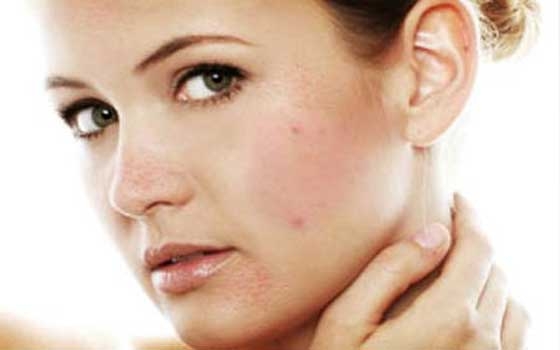   مصر اليوم - أسباب حب الشباب والرؤوس السوداء وطرق علاجها