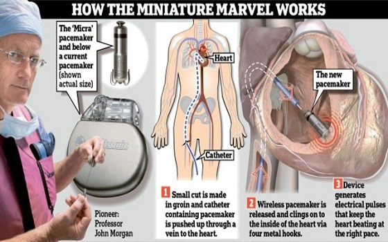   مصر اليوم - زراعة جهاز لاسلكي بحجم حبة دواء داخل قلب