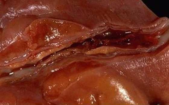   مصر اليوم - استخدام تقنية جديدة لإنقاذ حالات جلطة الشريان التاجي