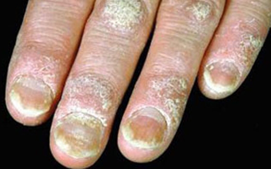   مصر اليوم - نتائج أولية مبشرة لفاعلية عقار جديد معالج للصدفية