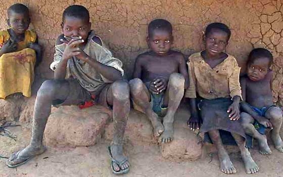   مصر اليوم - سوء التغذية الحاد يعرض أطفال جنوب السودان للموت