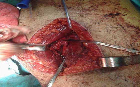   مصر اليوم - إجراء العملية الأولى لتوصيل شرايين وأورده لساق مريض في العريش