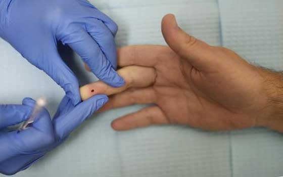   مصر اليوم - نحسار نسبة الإصابة بفيروس نقص المناعة المكتسبة في الولايات المتحدة