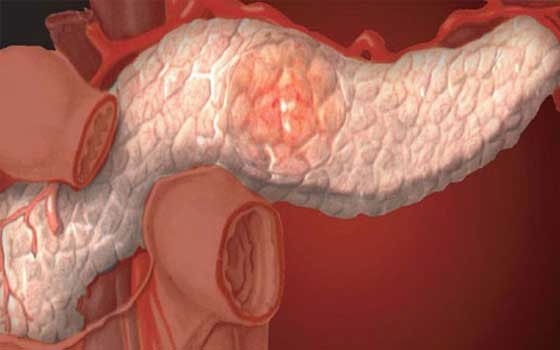   مصر اليوم - أسلوب الحياة الصحي يحمي من الإصابة بسرطان البنكرياس