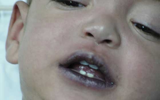   مصر اليوم - الطفل الأزرق الذي كان يصيب الأمهات انتقل إلى الآباء