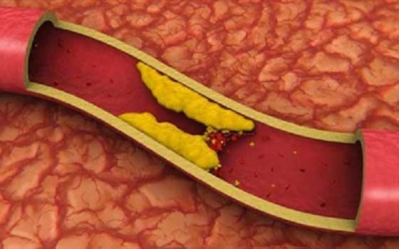   مصر اليوم - مستويات الكوليسترول المرتفعة قد تزيد فرص الإصابة بسرطان الثدي