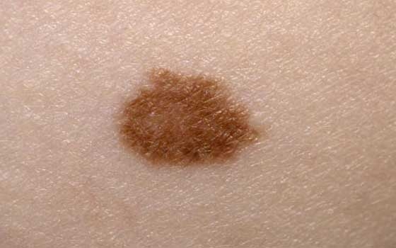   مصر اليوم - تطوير عقار جديد يحفز المناعة لمحاربة سرطان الجلد