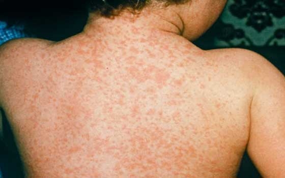 مصر اليوم - وزير الصحة في سنار يلتقي وفد برنامج التحصين الإتحادي