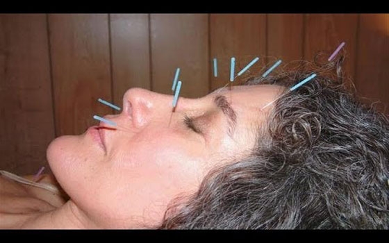   مصر اليوم - دراسة أثبتت أن الوخز بالإبر الصينية يقلل من الهبات الساخنة لإنقطاع الطمث