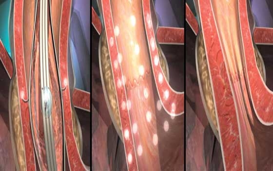   مصر اليوم - العلاج القائم على التردد الإشعاعي يعمل كجسر بين الأدوية والجراحة