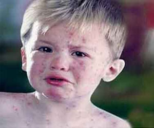 مصر اليوم - رعب فى قرى أبوتيج بعد إصابة تلاميذ بالجدرى