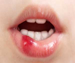 مصر اليوم - امراض اللثة مرتبطة بالصدفية